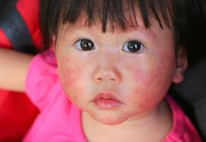 Understanding Baby Food Allergies. Food Allergy Awareness